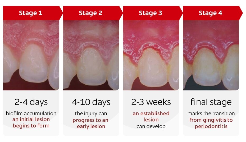 evolución-de-periodontitis