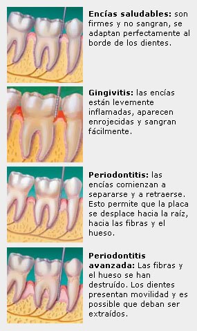 enfermedad de las encías