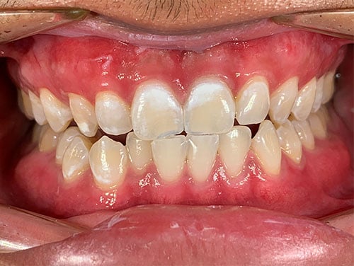 fluorosis-dental-en-incisivos-centrales-superiores
