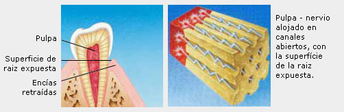 sensibilidad dental