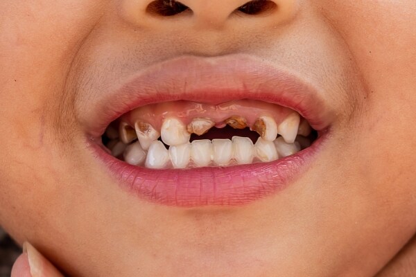 Niño con caries