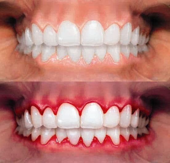 Full teeth and gums at front view before and after.pdf