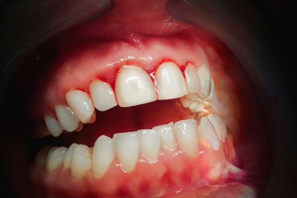 Dientes con sangre en las encias