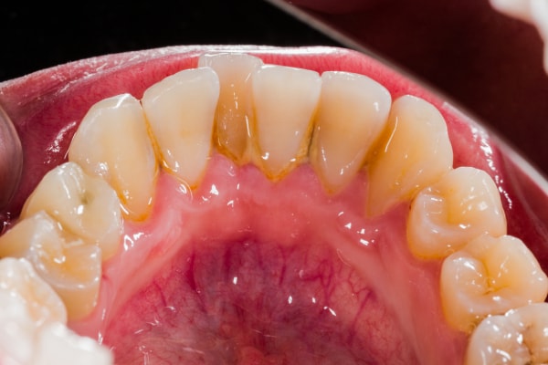 Sarro en dientes