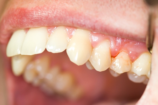 Dientes amarillos con placa