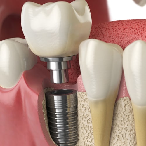 anatomía dientes saludables diente implante dental